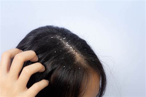 Scalp Yeast Infection: Causes, Symptoms and Treatment