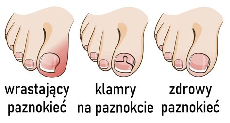 Wrastające paznokcie klamry Płyn Dobra maść