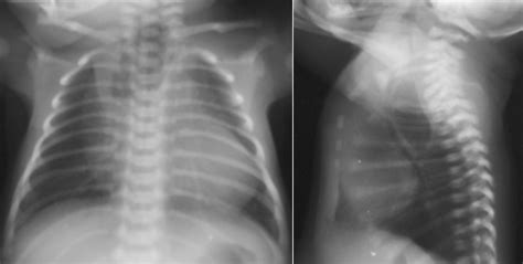 Transesophageal Fistula - Pediatrics - Medbullets Step 2/3