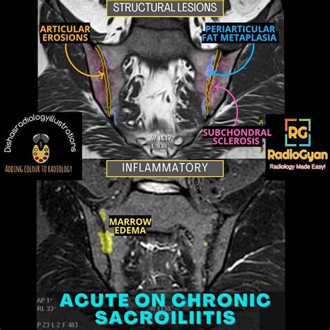 Sacroilitis Radiology Case Radiogyan