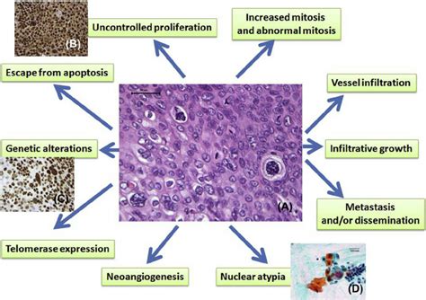 Malignant Melanoma Histology