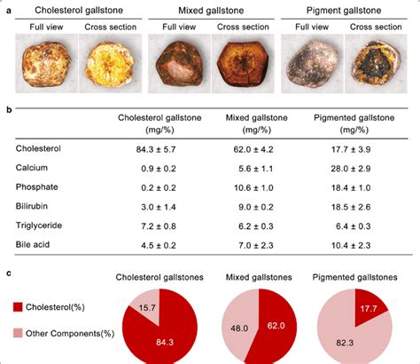 Gallbladder Stones In Stool