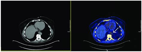 Fusion 18F NaF PET CT Images Depicting NaF Uptake In The Descending