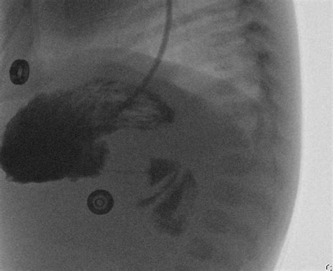 Pyloric Stenosis String Sign