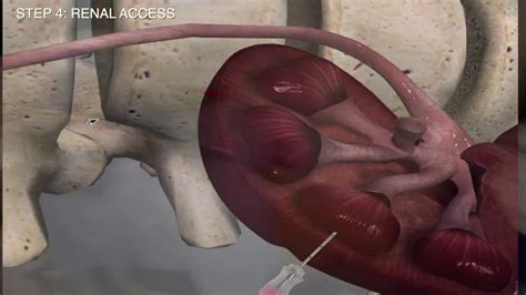 Complete Supine Percutaneous Nephrolithotomy STEP By STEP Technique