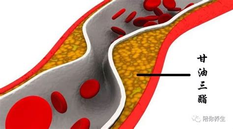 甘油三酯高可能会引发疾病 5点小建议帮你降下来人体