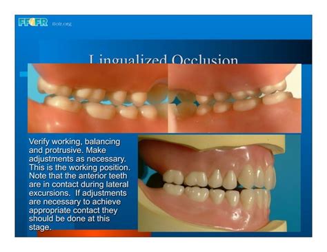 Complete Dentures 16occlusal Schemes Lingualized Occlusion