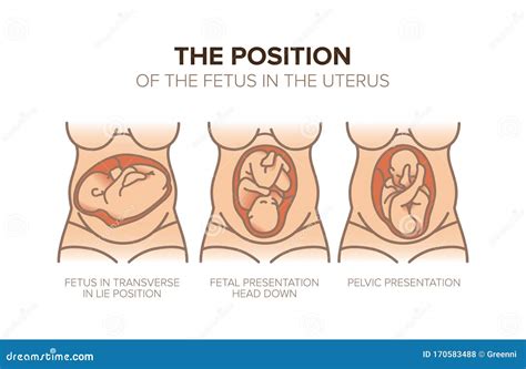 Position Du Foetus Dans Le Ventre Grossesse Illustration De Vecteur