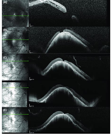 Preoperative And Postoperative Oct Scans Of A Patient With A Mh And Md