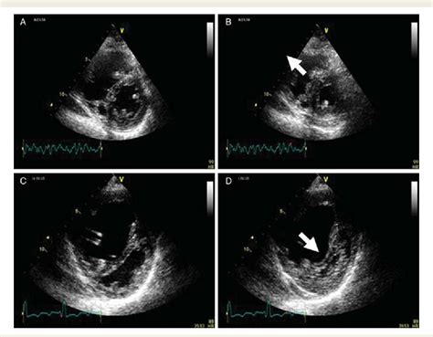 Table 2 From The Echocardiographic Assessment Of The Right Ventricle