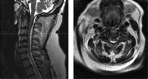 Etiology And Surgical Management Of Cervical Spinal Epidural Abscess