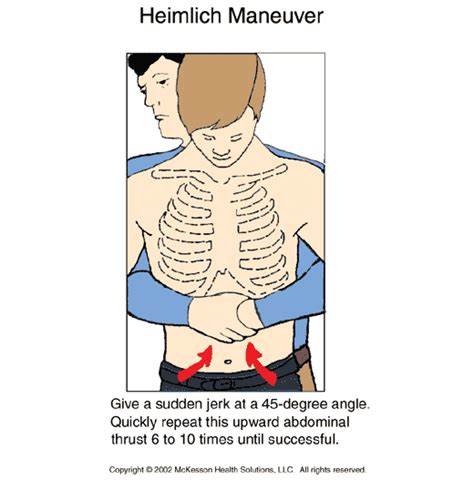 Premier Care Pediatrics Patient Information Heimlich Maneuver Illustration