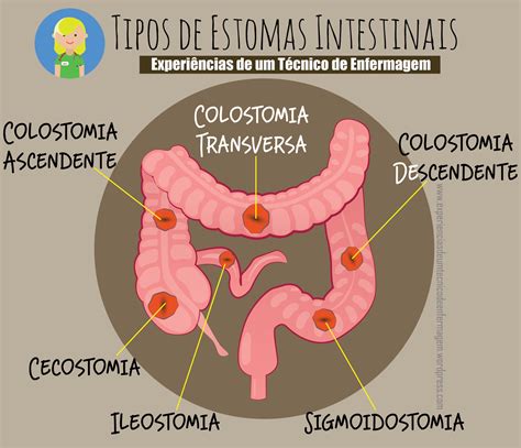 Colostomia E Ileostomia - Diferença Entre Colostomia E Ileostomia - ZULEDU
