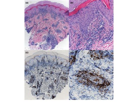 A Haematoxylin Eosin 49 Stain Hydropic Degeneration Of The Basal