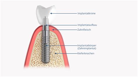 Implantat Oder Stiftzahn ECDI