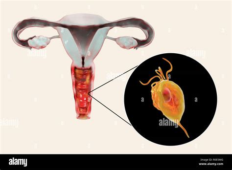 Trichomoniasis Illustration Computer Illustration Of The Female Reproductive System And The