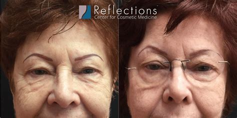 Exilis Ultra Non Surgical Face Lift Skin Tightening For Patient In