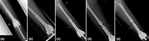 Serial Radiographs A To E Showing A Patient With A Non Invasive