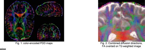 Figure 1 From High Resolution Diffusion Tensor Imaging DTI Of The