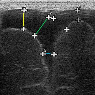 Para Coronal Scan Obtained Through The Anterior Fontanelle Of A Very