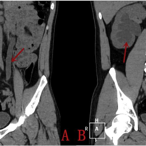 Computed Tomography Showing Bilateral Ureterectasis Arrow A And