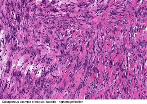 Pathology Outlines Nodular Fasciitis