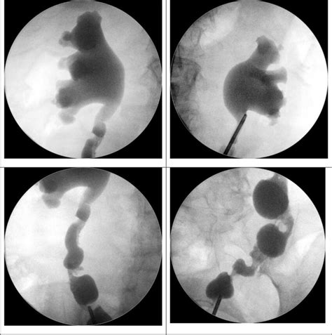 Representative retrograde pyelography (RP) images after Yang–Monti... | Download Scientific Diagram