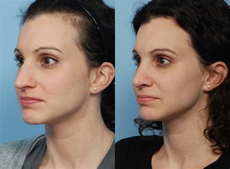 The Facts About Rhinoplasty In Jackson MS Nose Reshaping Surgery