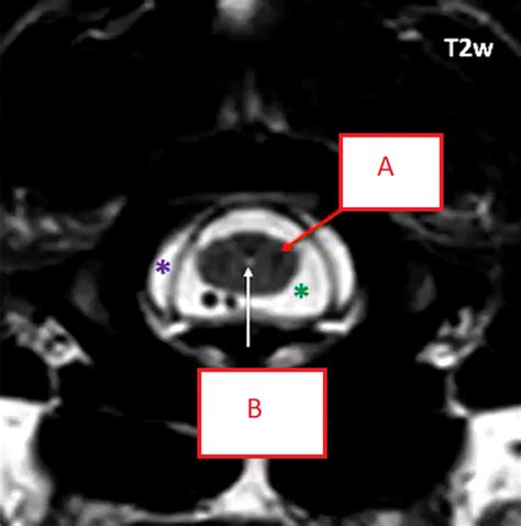 Spinal Cord MRI Flashcards | Quizlet