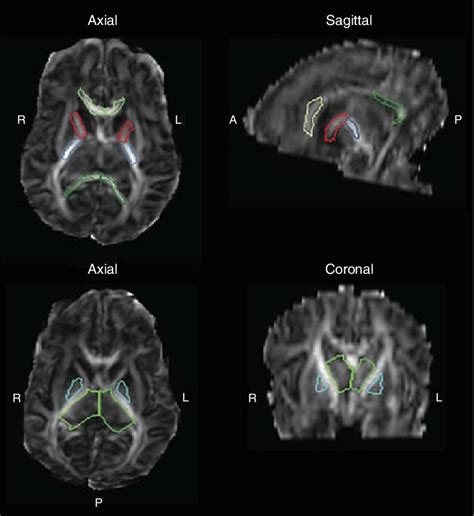 Brain White Matter Microstructure Regions Of Interest Selected On A