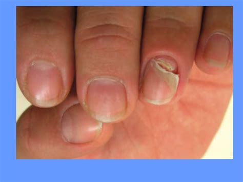 Nail Disorder Dr Aisha Almoosa Ppt