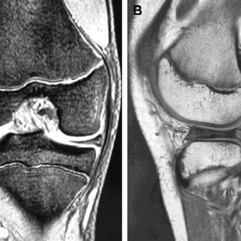 A Fat Suppressed T Weighted Coronal Image Of The Right Knee In A