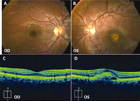 Fundus Photographs And Optical Coherence Tomography Oct Scans Of