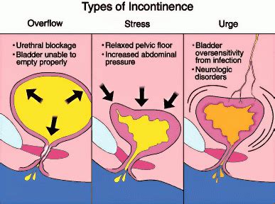 T Stress Urinary Incontinence