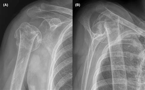 Anterior Posterior A And Lateral B Radiographs Obtained At 4 Months