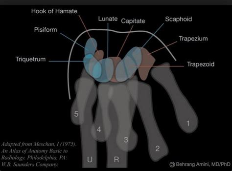 Hook of Hamate Fracture - Hand - Orthobullets