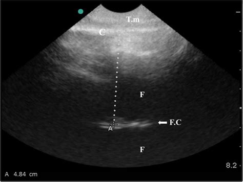 Hydranencephaly Ultrasound