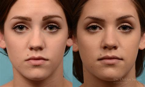 Dr Oakley Smith Rhinoplasty Before And After Case 293