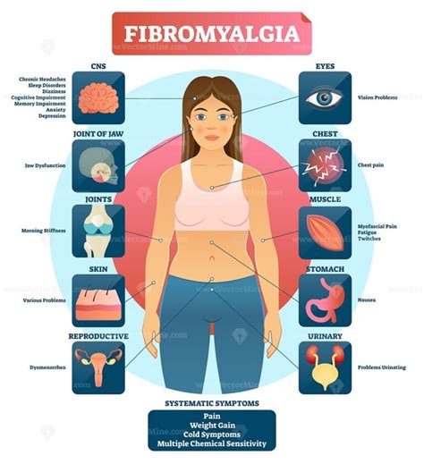 Fibromyalgia as musculoskeletal pain disorder tender points outline ...