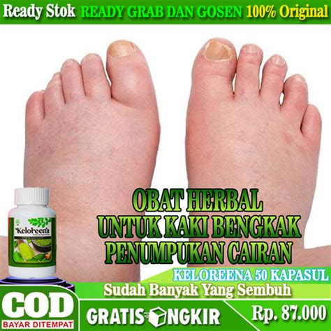 Jual Obat Herbal Untuk Edema Kaki Bengkak Obat Penumpukan Cairan Di