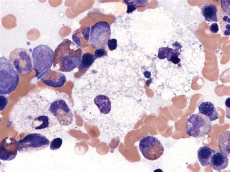 Niemann Pick Cells In Bone Marrow Stock Photo Image Of Histiocyte