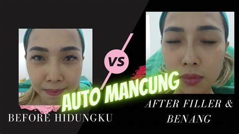 Pengalaman Filler Tanam Benang Hidung Part2 Youtube