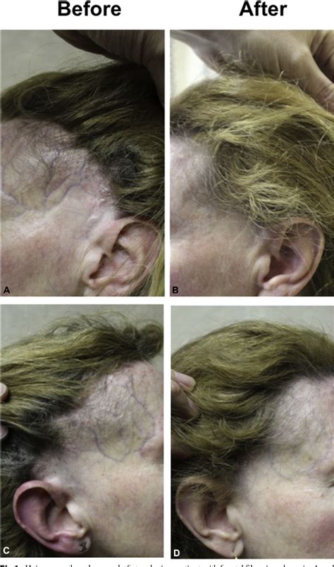 Figure 1 From Finasteride Mediated Hair Regrowth And Reversal Of