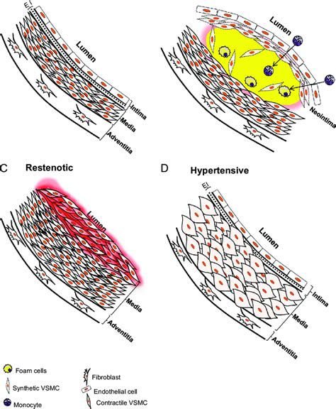 Illustration Of VSMCs In Healthy And Diseased Arteries A The Mature