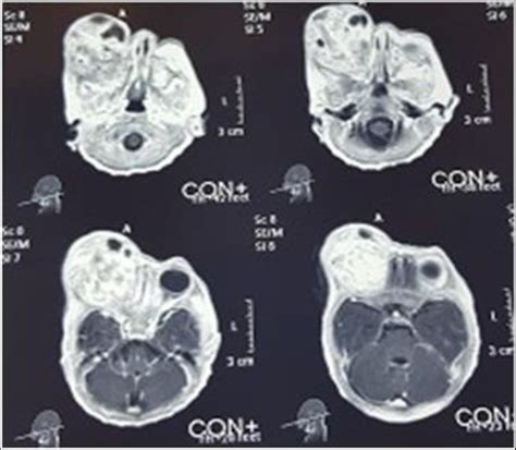 Axial T1 Post Contrast MRI Showing A Heterogenous Mass In Right Orbit