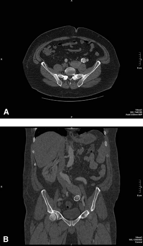 Figure 1 From Repair Of A High Flow Iliac Arteriovenous Fistula Using A