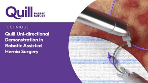 Quill Uni Directional Demonstration In A Robotic Assisted Hernia