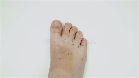 Human Legs With Dermatitis Allergy Rash Close Up Of Male S Foot And