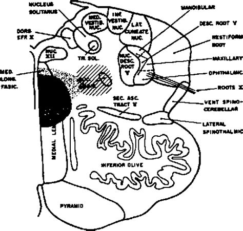 Lateral Medullary Syndrome | Semantic Scholar