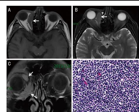 Figure 1 From Predicting The Prognosis Of Primary Orbital Lymphoma By Clinical Characteristics